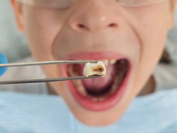 Best Emergency Tooth Extraction in Rock Falls, IL